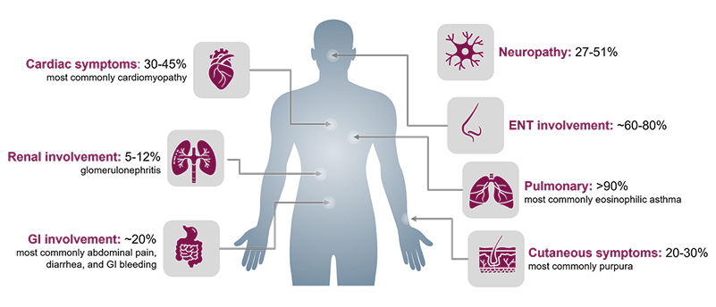 Proportion of EGPA patients with clinical signs/symptoms